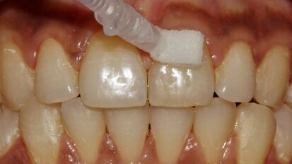 Curodont Repair Fluoride Plus and Curodont Protect―a biomimetic approach to effective early caries management