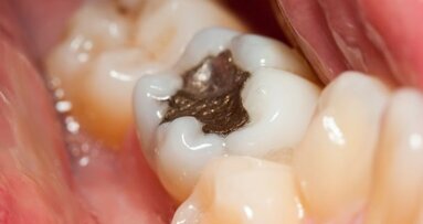 Amalgam alternatives less harmful to environment
