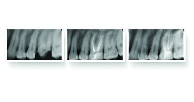 Revolutionizing Endodontics with Fotona SWEEPS Technology