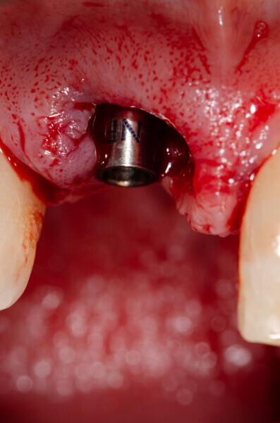 Fig. 16a: Implant with the titanium base inserted, anterior view.