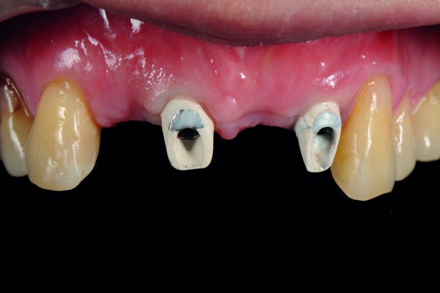 Fig. 15: Insertion of provisional abutments.