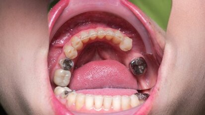 UE apoia proibição de amálgama em crianças e mulheres grávidas ou lactantes