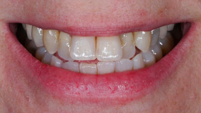 Individualisation of monolithic zirconia restorations