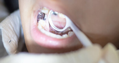 Stufenweise Reduzierung von Amalgam läuft schleppend