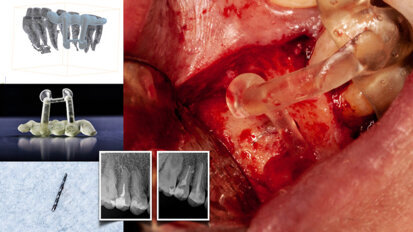 Dynamic navigation—The future of minimally invasive endodontics Dynamic navigation—The future of minimally invasive endodontics