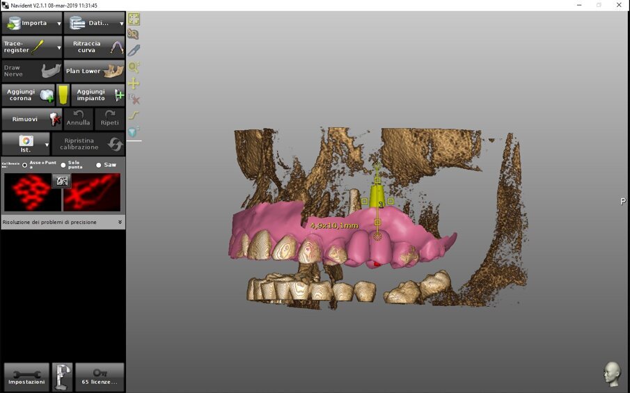Figg. 3a, 3b - La registrazione di un modello con ceratura diagnostica nel software Navident® by Claronav®. a) Identificazione di punti di accoppiamento; b) integrazione finale del modello con ceratura diagnostica nel software per la pianificazione. N.B. Questo uso dell’algoritmo di registrazione è esclusivamente diagnostico in una tecnica di chirurgia navigata.