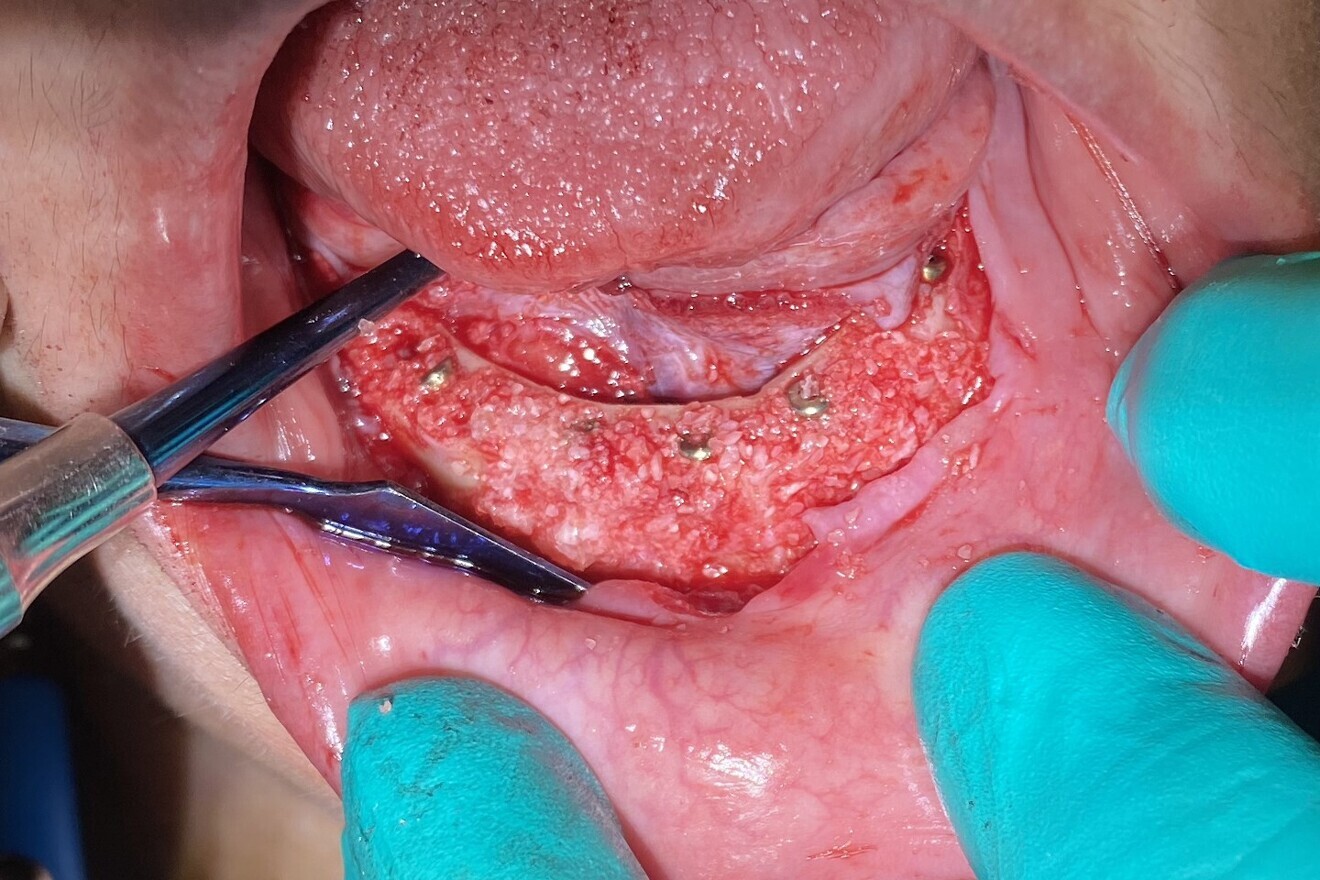 Fig. 15: Dentine graft covering socket defects.