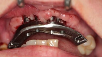 Kompromisowe leczenie implantoprotetyczne w strefie estetycznej