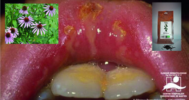 La place de la phytothérapie dans le traitement des lésions buccales