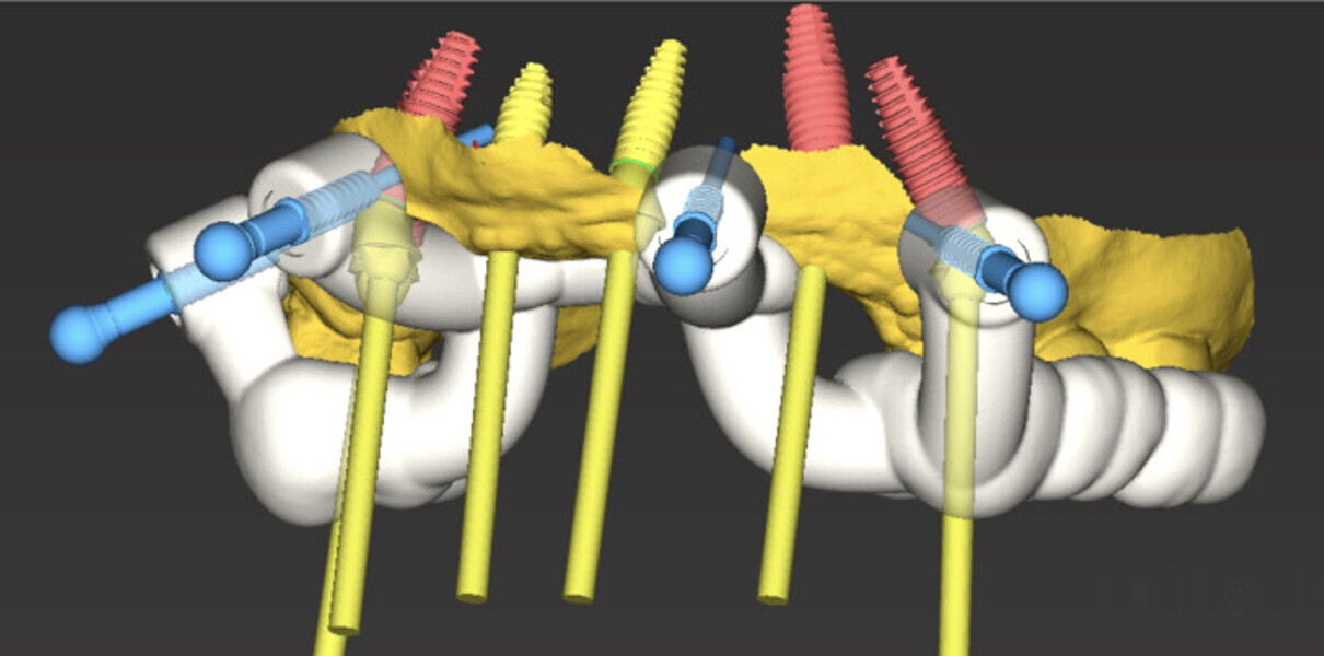 Fig. 8a: Anchor pin guide design ... 