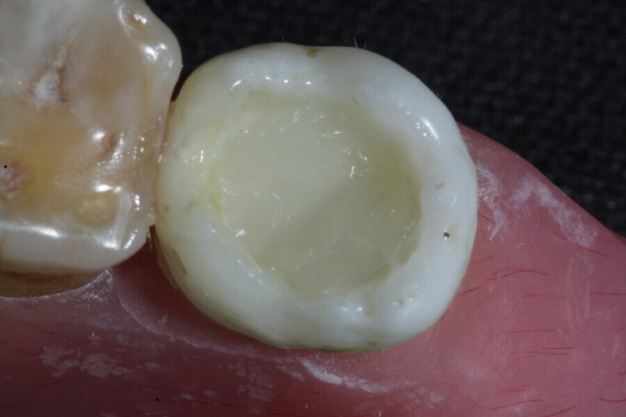 Fig. 27b: The subsequent dose of fibre-reinforced membrane cube is placed to protect the remaining walls of the cavity.