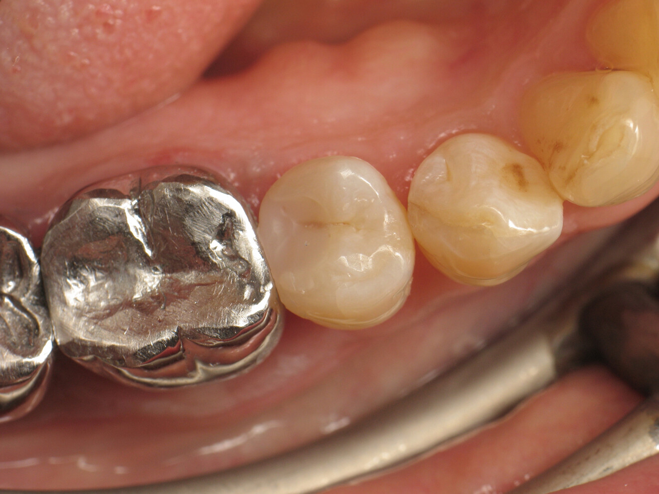 Fig. 22: Completed restoration after polishing.