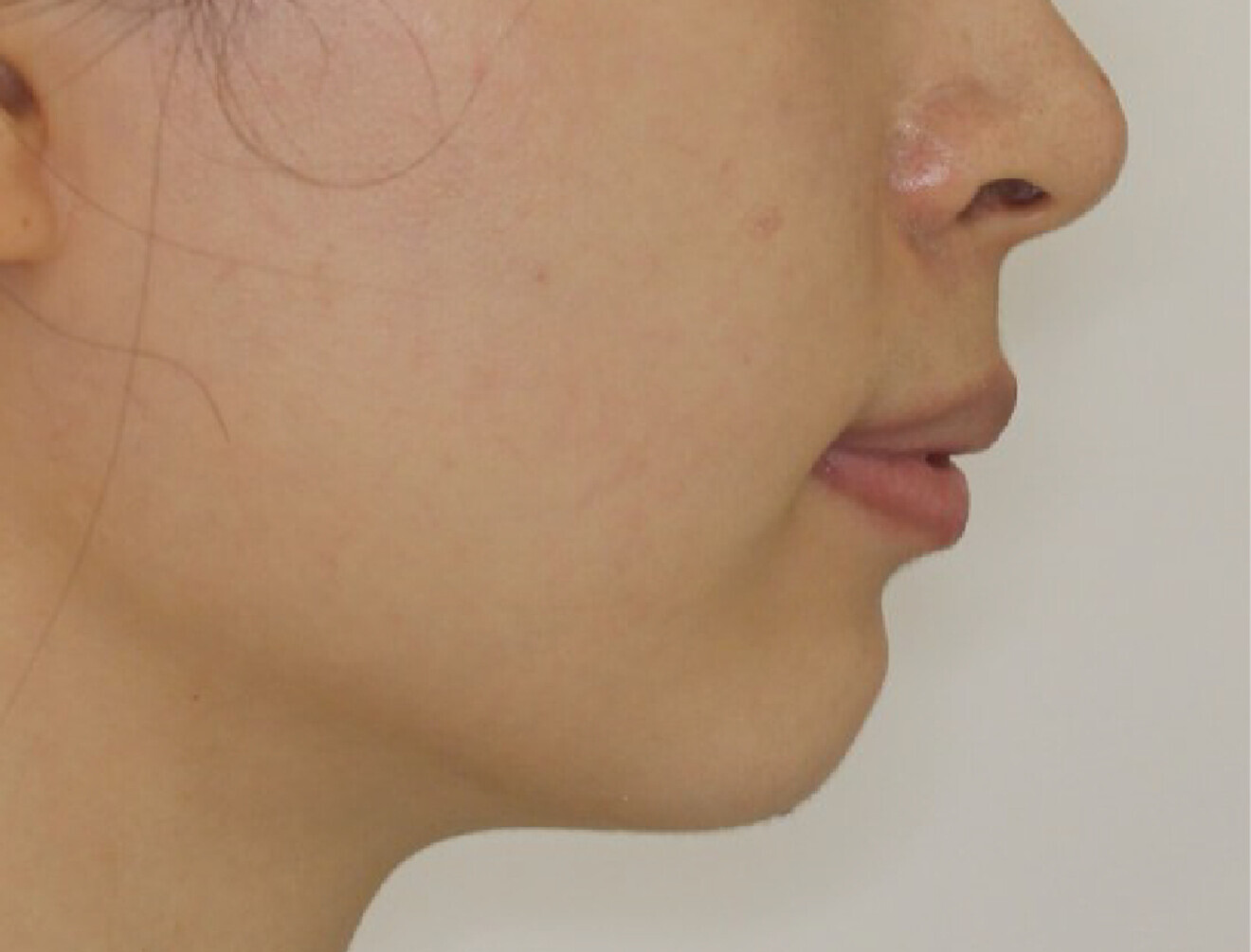 Fig. 1c: Facial profile.
