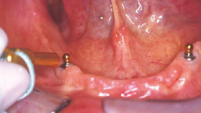 Soluzioni per attacchi