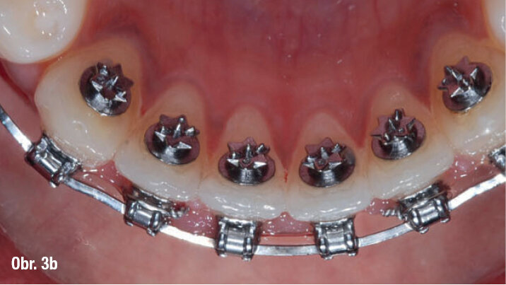 Doporučené umístění TS2 – o trochu více gingiválně u horních řezáků