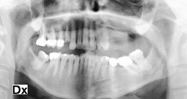 L’utilizzo dei derivati piastrinici nel grande rialzo di seno mascellare