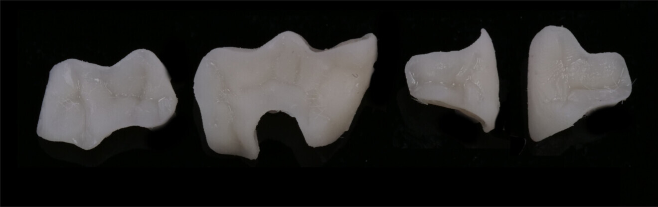 Fig. 25: Restorations after finishing.