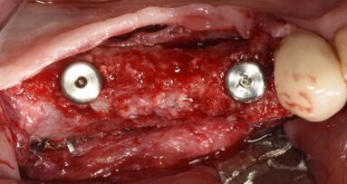 G.B.R di un grave difetto osseo orizzontale e verticale della mandibola con griglia in titanio