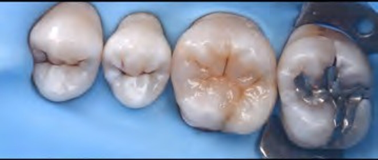  Fig. 2j: Final  polishing completed to achieve optimal surface gloss and anatomical integration. 