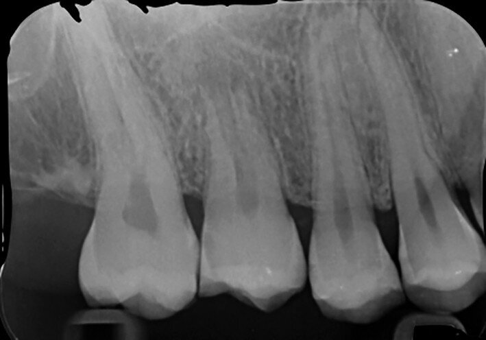 Fig. 19d: Radiographs: Two-year recall.