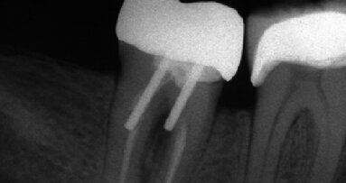 Hlavní zásady, které zvyšují úspěšnost rekonstrukce endodonticky ošetřených zubů