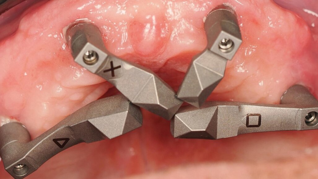 Quando il dato smette  di essere una promessa: ScanLogiQ, convergenza nella scansione implantare