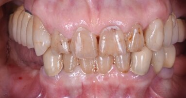 Risoluzione di una grave atrofia ossea con la tecnica della lamina corticale e materiali innovativi