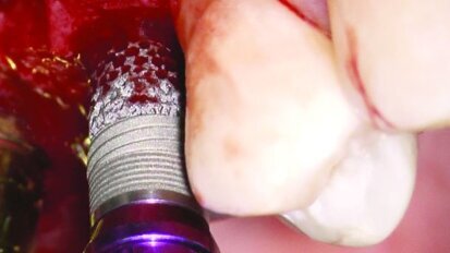 Zimmer lance un implant avec une fonctionnalité d'ostéo-incorporation