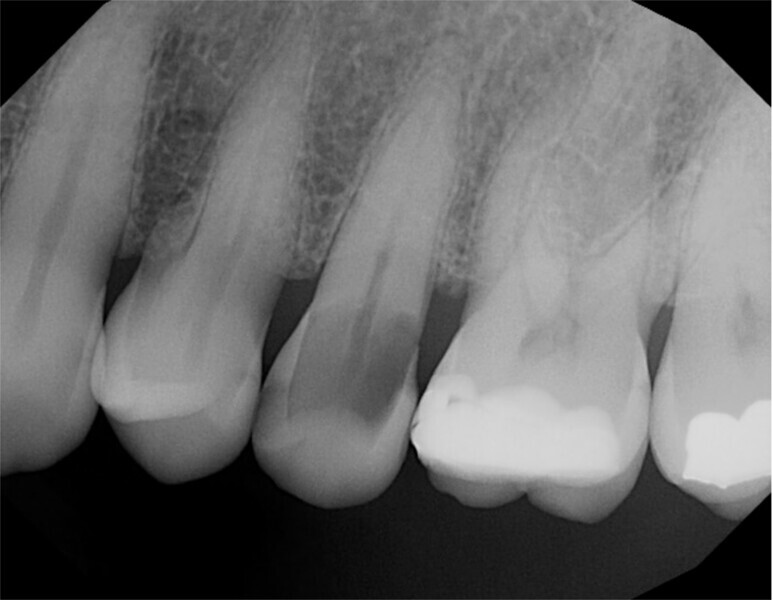 Fig. 13: Periapical radiograph demonstrating extensive caries in tooth #25 and an absence of periapical pathology.