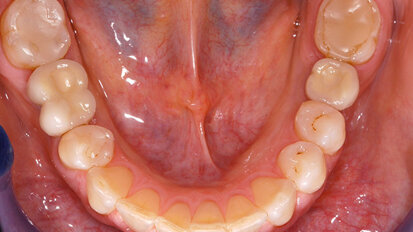 Long-Term Clinical Success with the Neoss Implant System: A Case Report