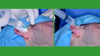 Tratamiento quirúrgico mínimamente invasivo de la ATM (2)