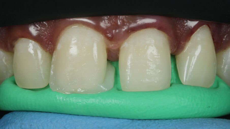 Fig 14: Palatal Shell layering using putty index