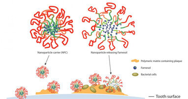 Nanopartikel im Kampf gegen Karies