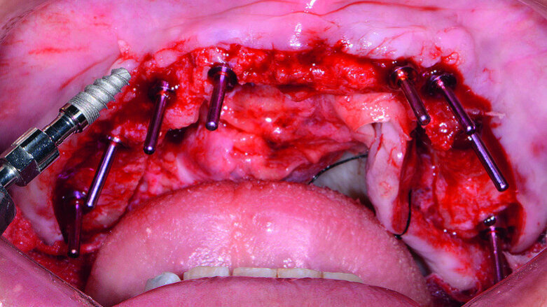 Incorporating CAD/CAM solutions for full-mouth dental implant reconstructions