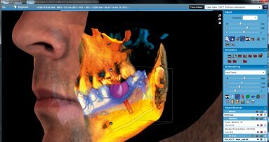 Planmeca Romexis®－CAD/CAM 工作与CBCT 数据处理均可在同一软件上完成