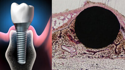 Forscher beschleunigen Osseointegration von Implantaten Forscher beschleunigen Osseointegration von Implantaten