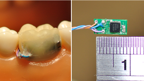 Sensor dental chinês pode facilitar o monitoramento do paciente