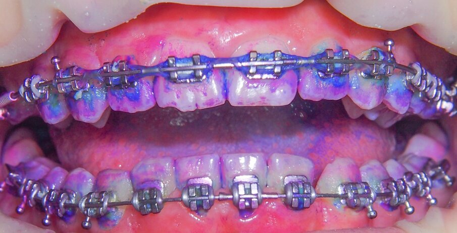 Fig. 3 - Applicazione del rivelatore di placca.