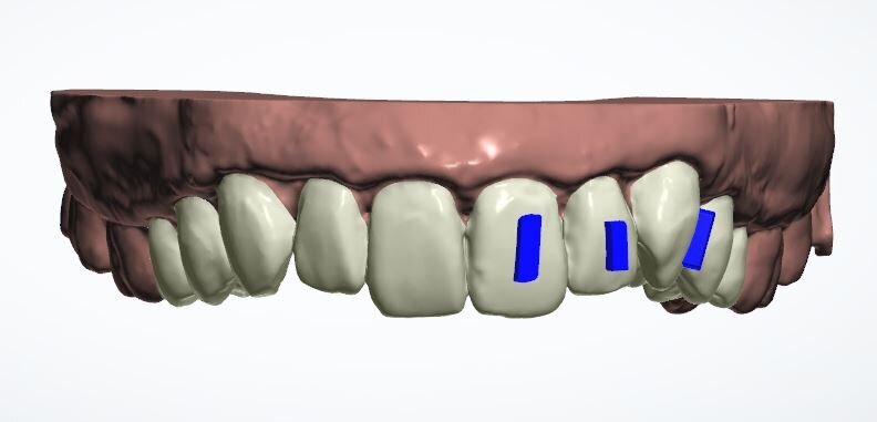 Fig. 13b: Three refinement aligners