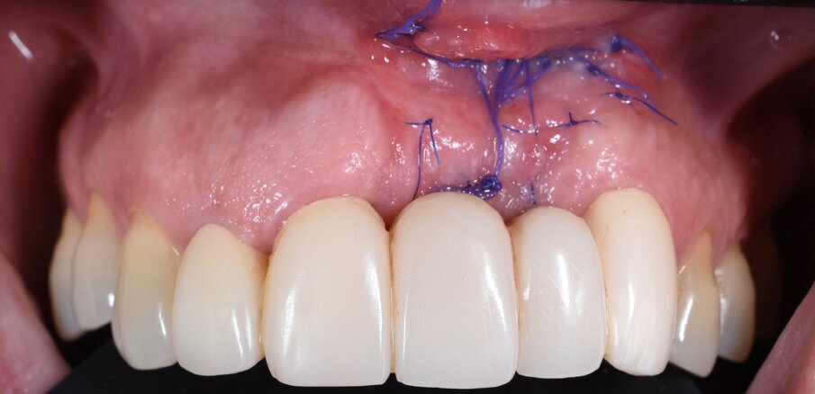 Fig. 11 - Controllo a 3 settimane dall’innesto.