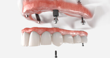Preferences for fixed restorations and resulting impact on the US and European overdenture markets