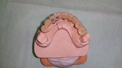 Alternatywna metoda wzajemnej stabilizacji transferów przy wykonywaniu wycisków