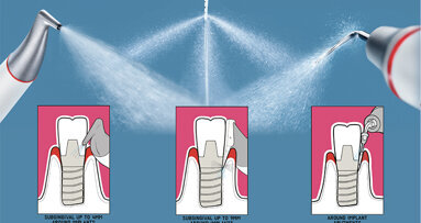Implant Maintenance with Guided Biofilm Therapy