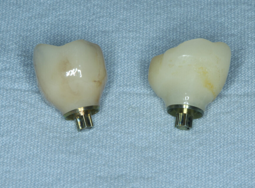 Fig. 23: Temporary crown removed and monolithic zirconia crown ready for insertion.
