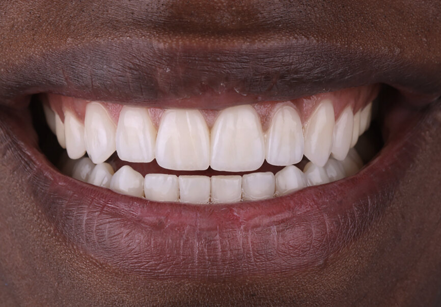 Fig. 85: Smile before and after the treatment.