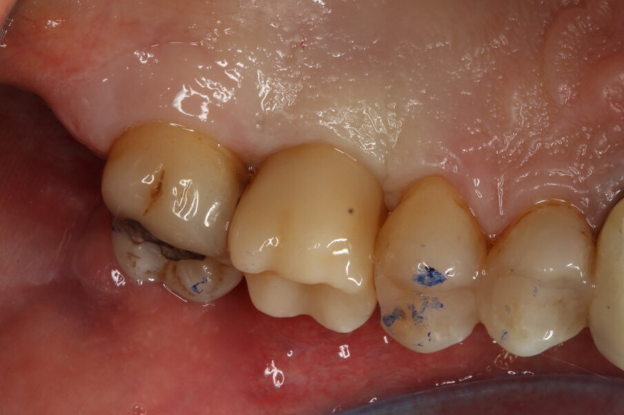 Fig. 13_Risultato clinico finale (versante palatale).