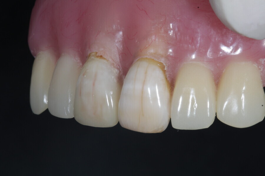 Fig. 19b: After finishing and polishing of the restoration.