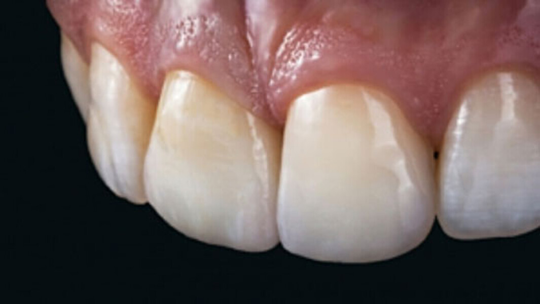 Fig. 14. La elección de distintos materiales para los incisivos centrales superiores se traduce en un resultado altamente estético con un juego de colores y luces natural.