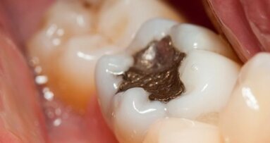 US regulators back down on dental amalgam issue