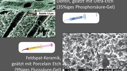 Online-Fortbildung: Zahmediziner gibt Tipps zur Adhäsivtechnik Online-Fortbildung: Zahmediziner gibt Tipps zur Adhäsivtechnik